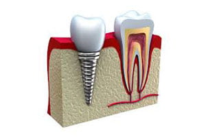 sinus-lifting-implant-dentar (Demo)