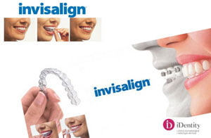 aparat dentar invizibil invisalign (Demo)