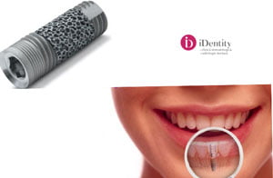 implant dentar pret (Demo)