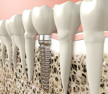 Osteointegrarea-implanturile-Megagen-AnyRidge (Demo)