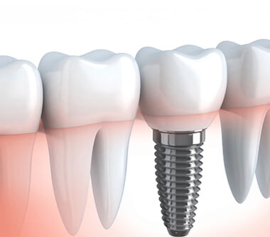 Implantul dentar calitatea pe primul loc (Demo)