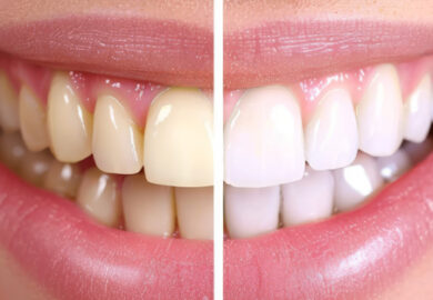 albirea dinților_albirea dentară_dinți galbeni_agenți de albire_identity albirea dinților_albirea dentară_dinți galbeni_agenți de albire_identity