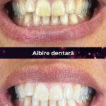 clinica stomatologica albire dentara bucuresti