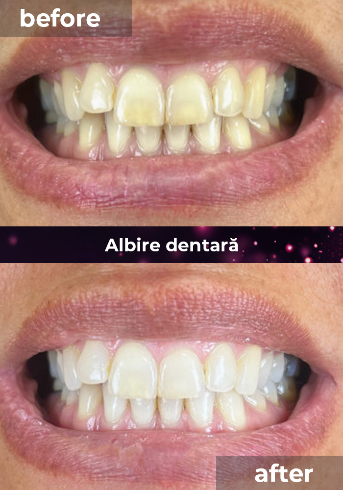 clinica stomatologica albire dentara bucuresti