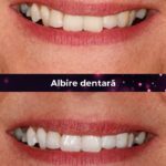 clinica stomatologica albire dentara bucuresti