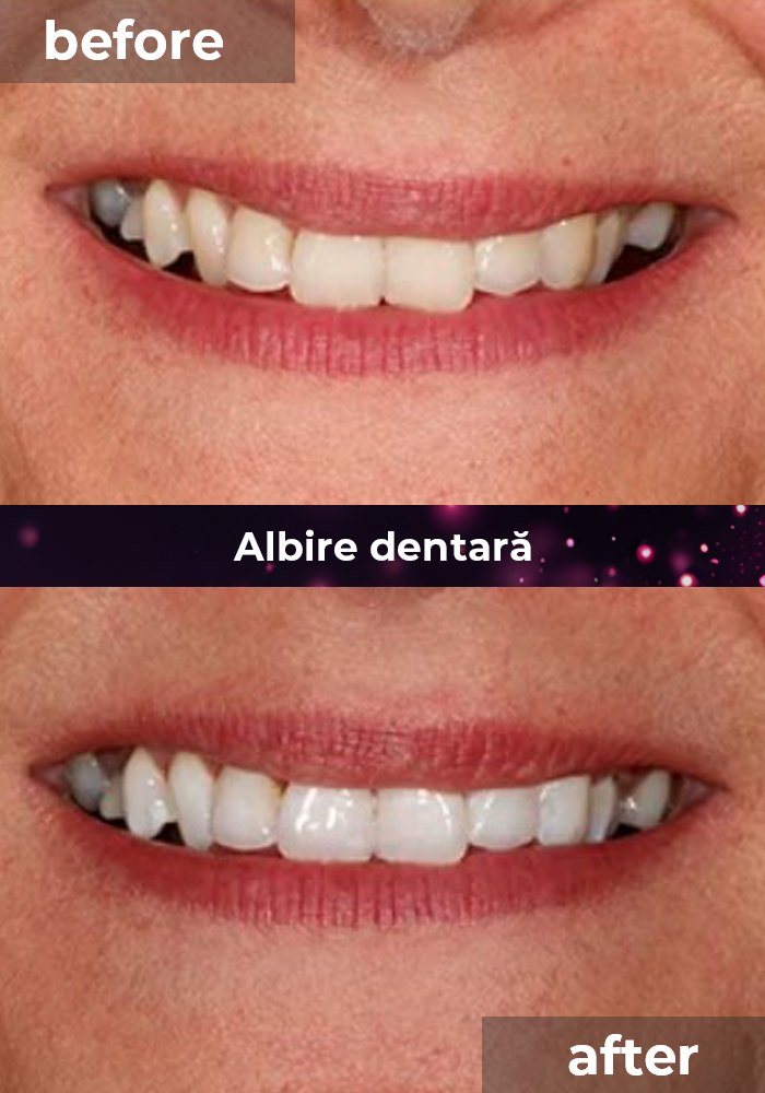 clinica stomatologica albire dentara bucuresti