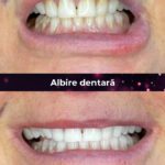 clinica stomatologica albire dentara bucuresti