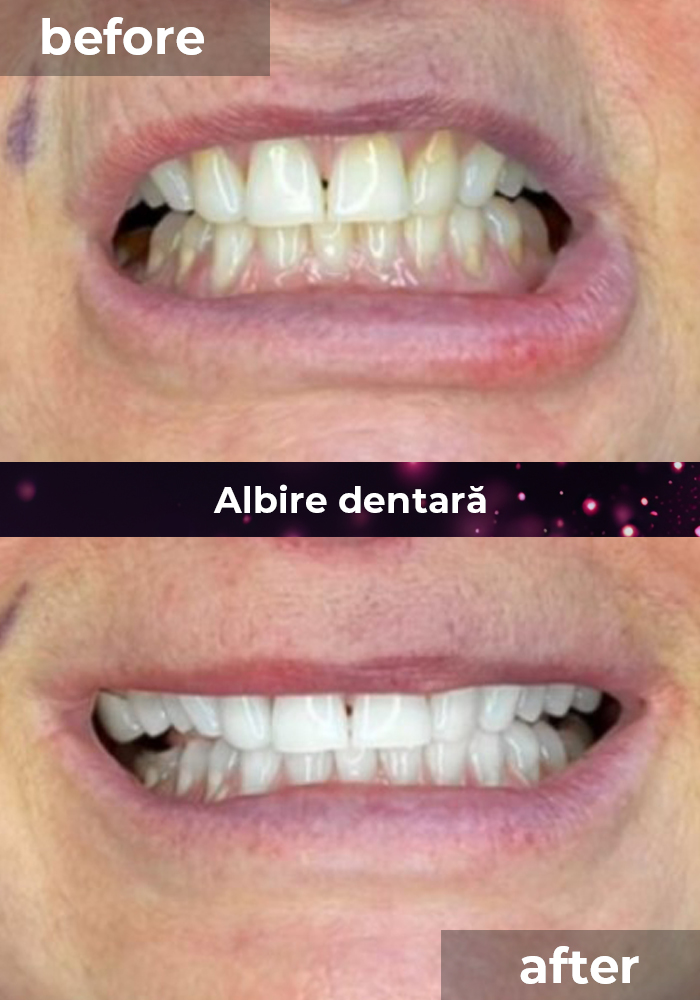 clinica stomatologica albire dentara bucuresti