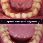 aparat dentar cu alignere