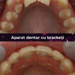 aparat dentar cu bracketi 2