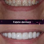 fatete dentare caz real bucuresti