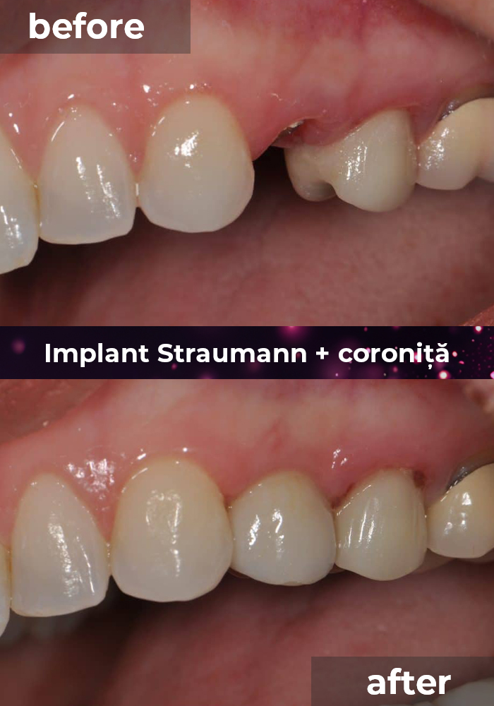 implant straumann coronita