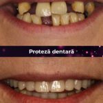 proteza dentara bucuresti