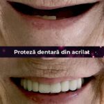 proteza dentara din acrilat
