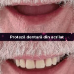proteza dentara din acrilat 2