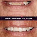 proteza dentara din acrilat 3