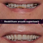 reabilitare arcada superioara
