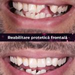 reabilitate protetica frontala