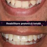 reabilitate protetica totala