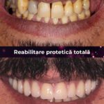 reabilitate protetica totala 2