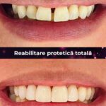 reabilitate protetica totala 3