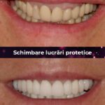 schimbare lucrari protetice