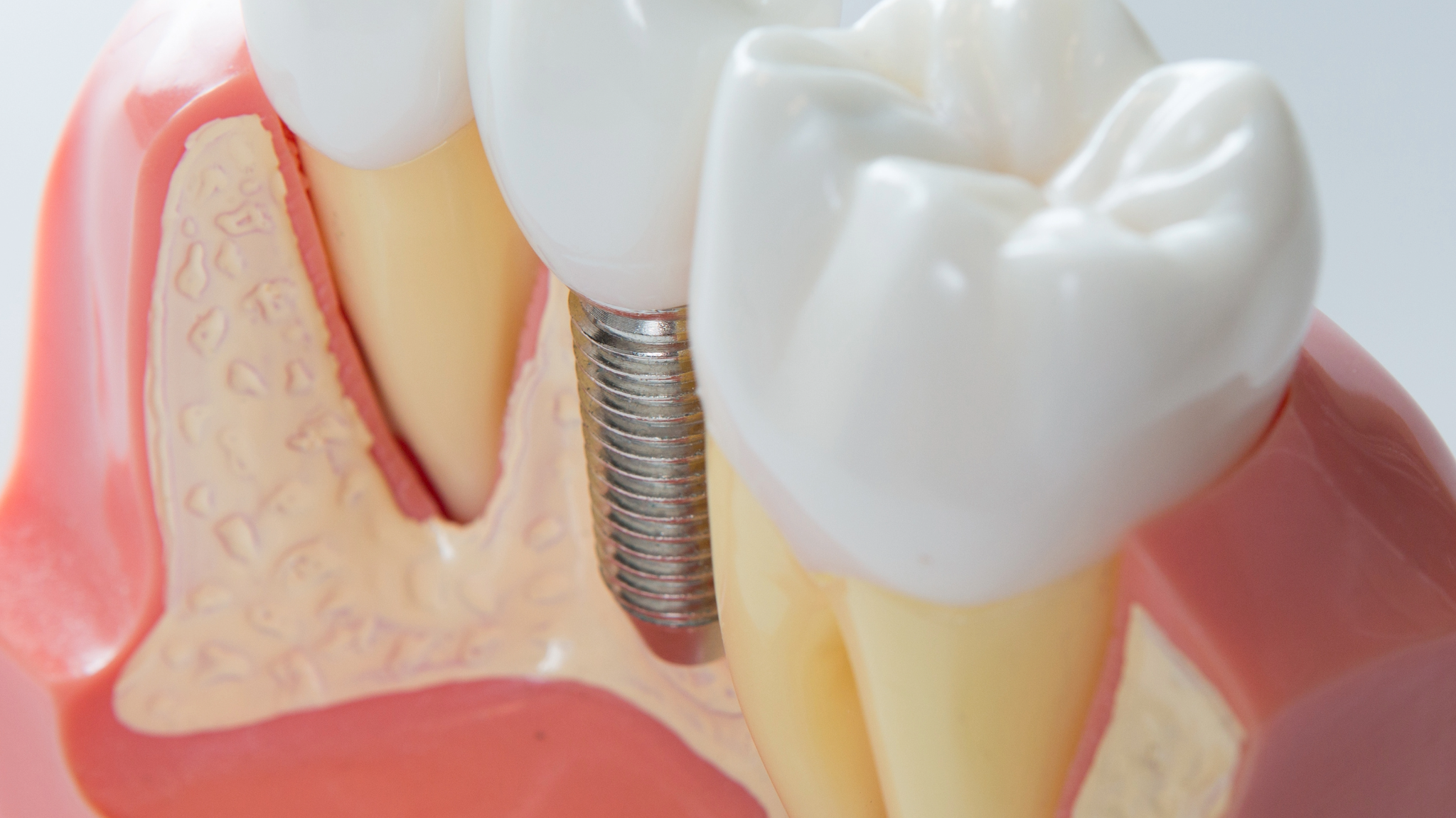 cat rezista un implant dentar? care e durata de viata a unui implant dentar?
