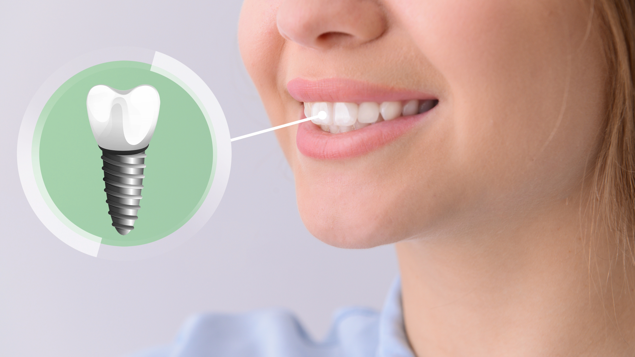 implant dentar bucuresti