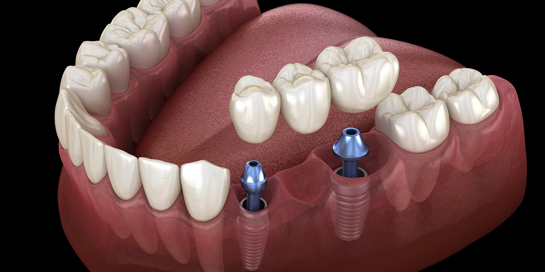 ce urmeaza dupa implant dentar, clinica implant dentar bucuresti