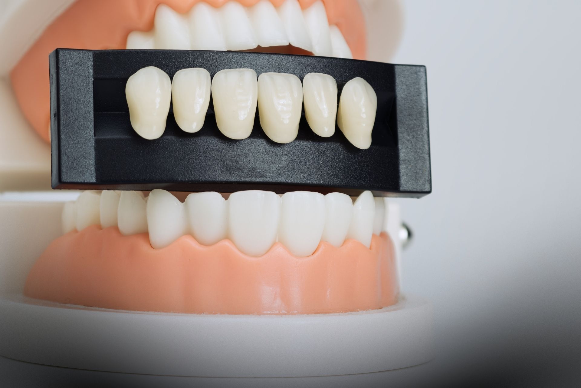 fatete dentare compozit