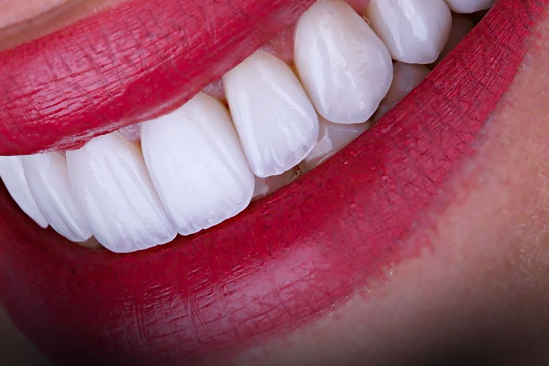 fatete dentare emax