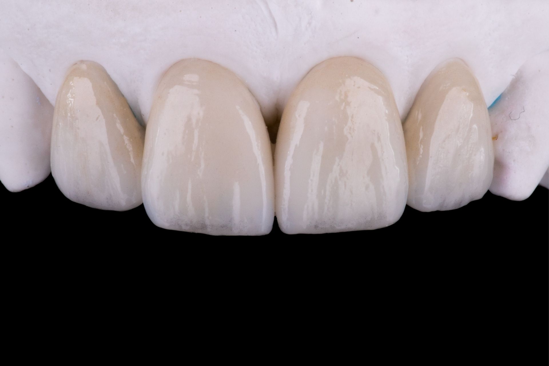 ce tipuri de fatete dentare exista