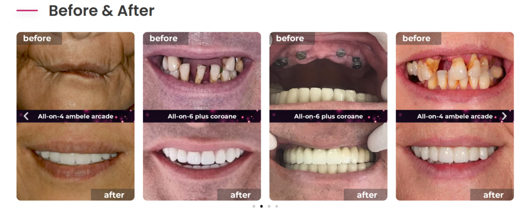 implant dentar recomandat de doctori