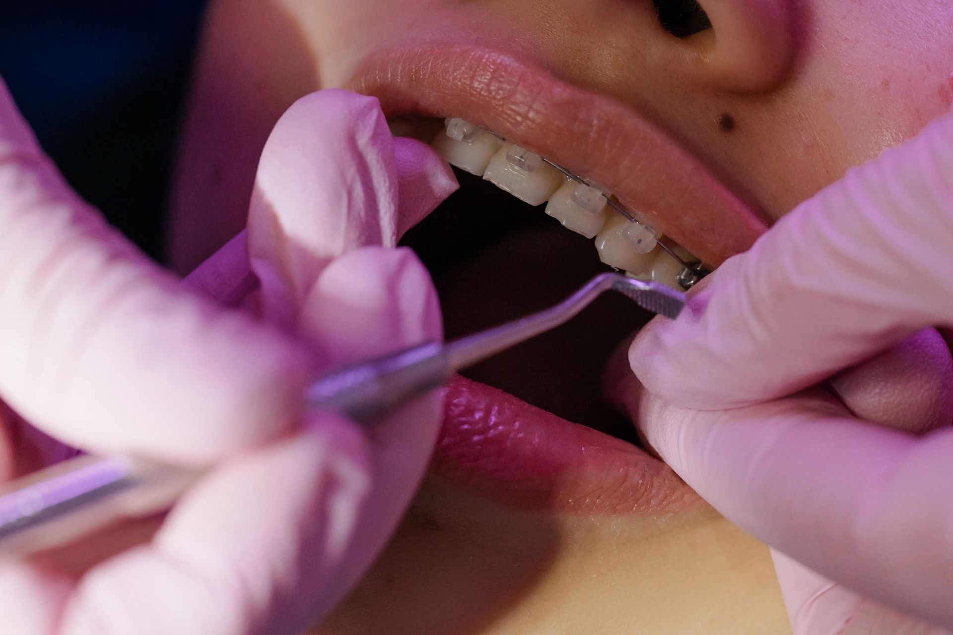 aparat dentar ceramic