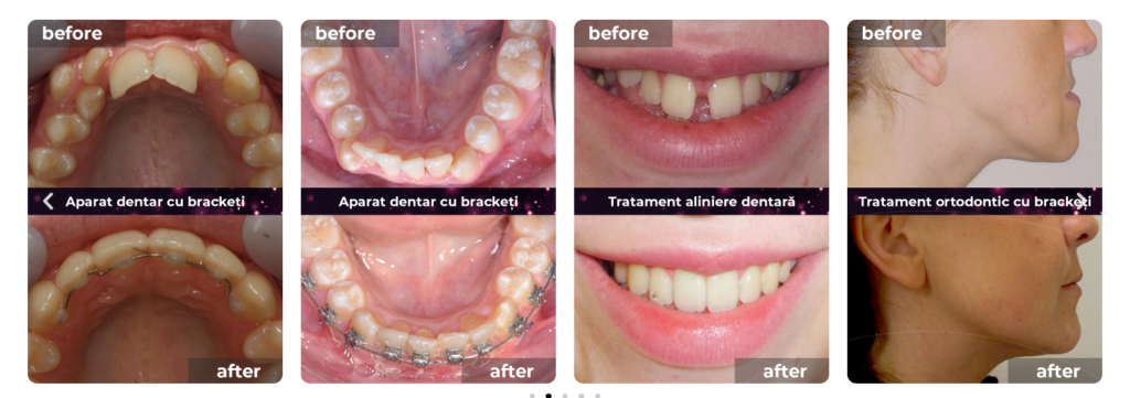 aparat dentar adulti