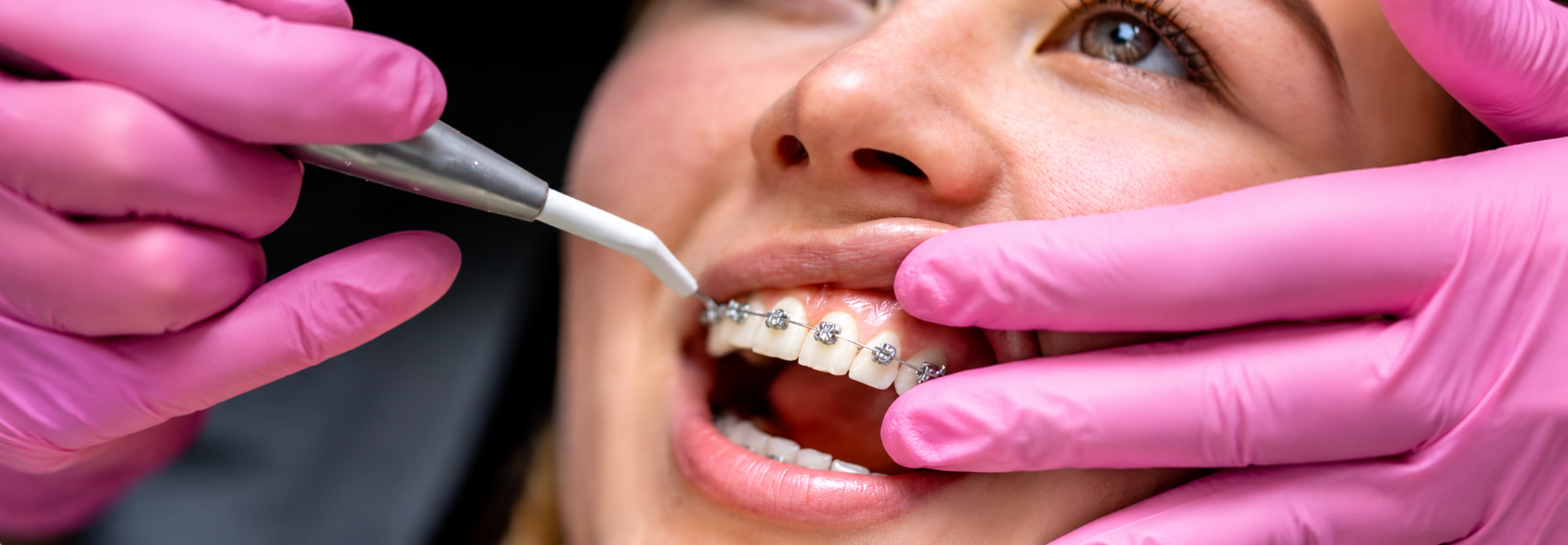 Află dacă poți purta aparat dentar după 30 sau 40 de ani, ce tipuri de aparate există, cât costă și care sunt beneficiile tratamentului ortodontic la adulți.