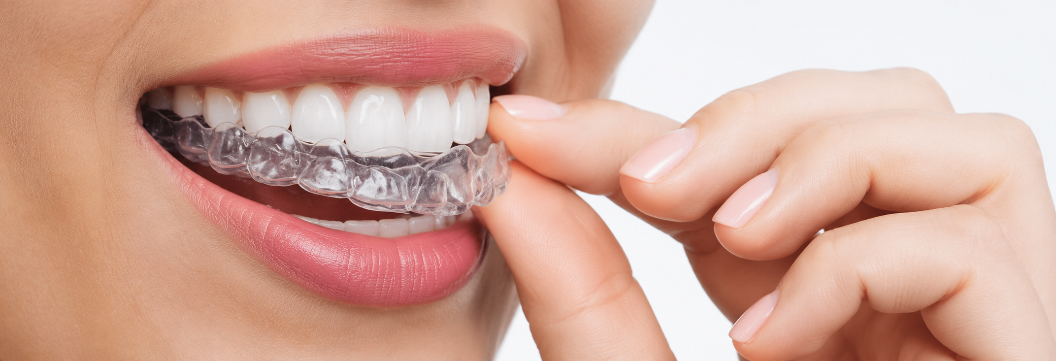 aparat dentar bucuresti 2026