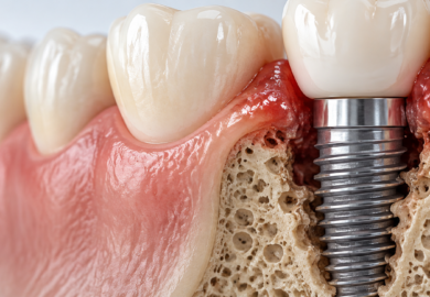 periimplantita poze infectie implant dentar periimplantita poze infectie implant dentar